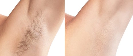 Chiropractic Springfield VA Hair Removal Armpit